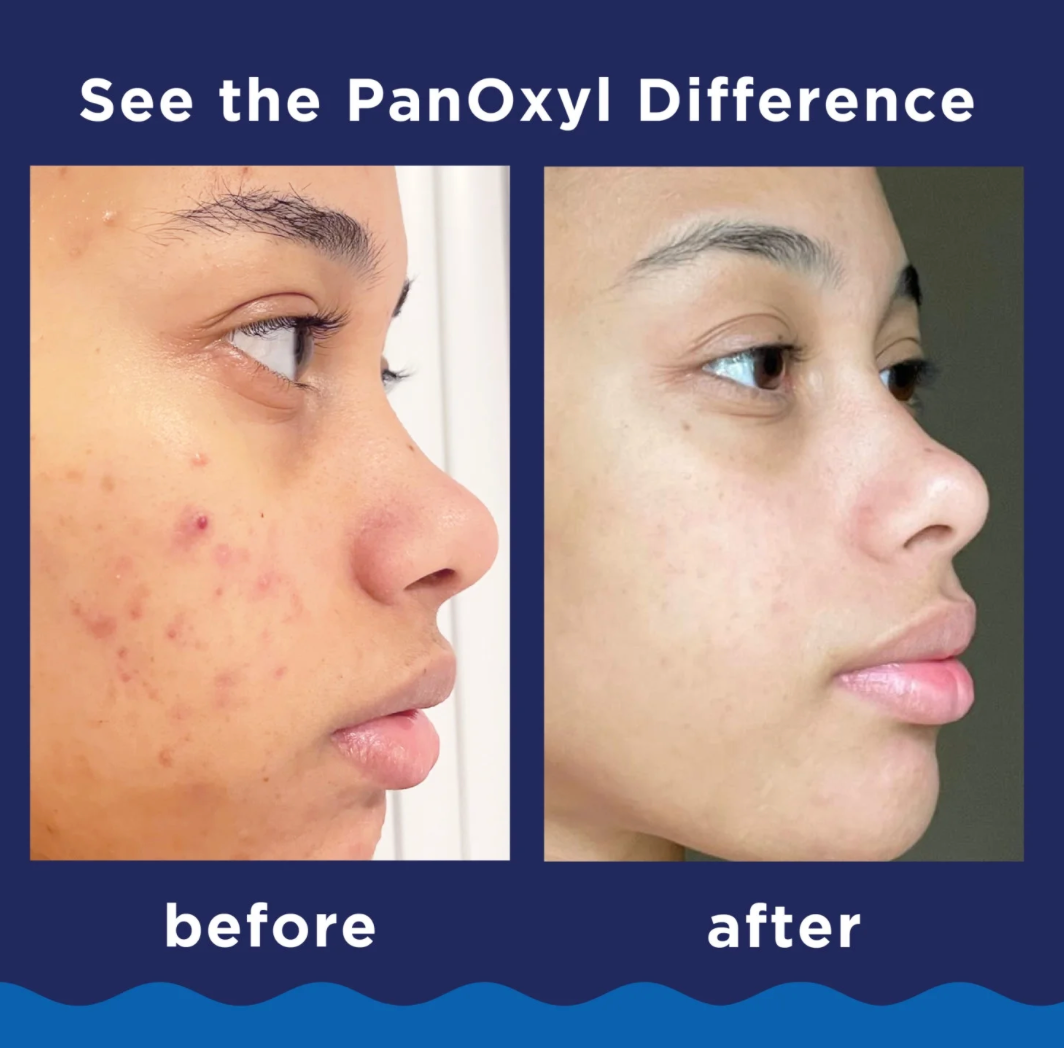 PANOXYL FOR FACE Y BODY 5.5OZ